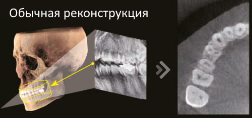 Обычная реконструкция изображения с томографа