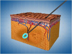 Разрушение глубокой жировой прослойки при помощи аппарата Deka SmartLipo