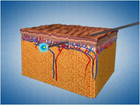 Разрушение поверхностной жировой прослойки, стимуляция синтеза коллагена при помощи аппарата Deka SmartLipo