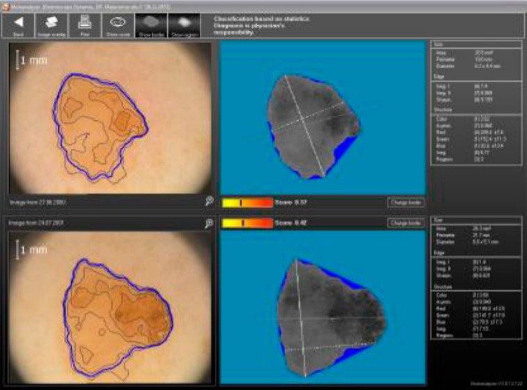 Процедура диагностики пигментного образования
