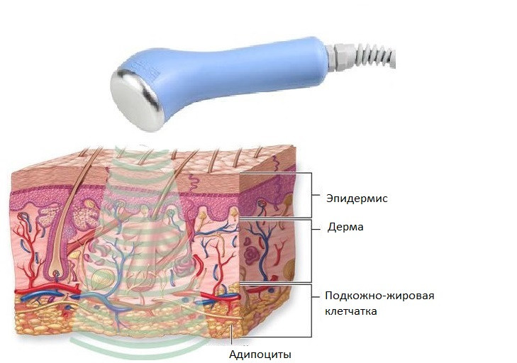 Схема воздействия ультразвука на слои кожи