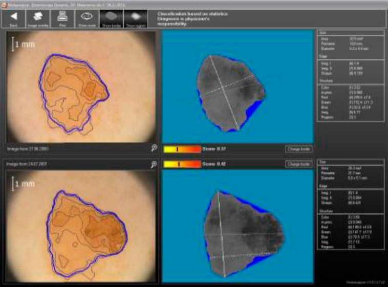 Диагностика пигментного образования в программе Moleanalyser Pro