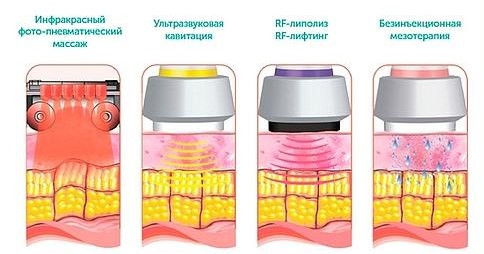 Воздействие 4 различных технологий аппарата Lumicell Wave 6