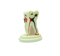 TOOTH MODEL S-TYPE - модель зуба с выделенными патологическими зонами