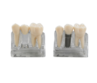 MODEL 2000 - модели, демонстрирующие имплантат и зубной мост