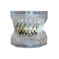 ЧВН-28П - денто-модель верхней и нижней челюстей для практики лечения пародонтоза