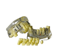 BIG IMPLANT MODEL - демонстрационная модель с имплантатами