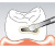 Sonicflex bevel №58 A - насадка для минимально инвазивной терапии кариеса с алмазным покрытием, мезиальная