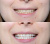 Amazing White Premium Teeth Whitening Kit 38% - набор для клинического отбеливания